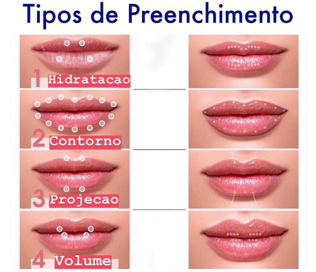 Diagrama de tipos de relleno labial, que muestra las opciones de hidratación, contorno, proyección y volumen con puntos de inyección punteados.