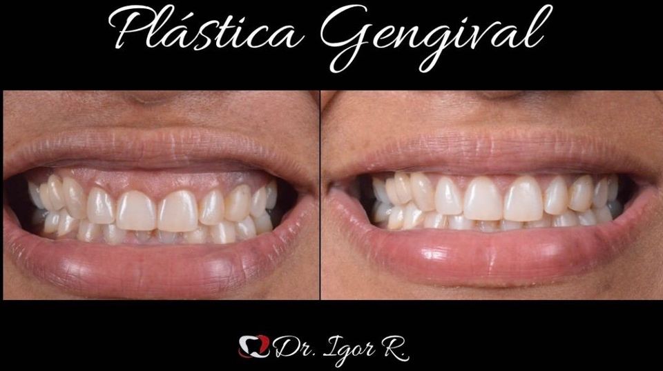 gengivoplastia em fortalesza-cirurgia plastica gengival