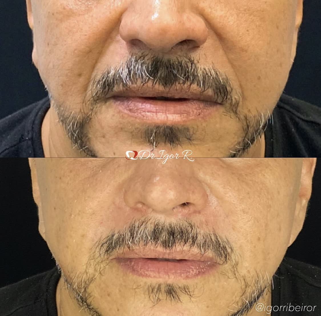 Comparação lado a lado do rosto de uma pessoa. A imagem inferior mostra a pele mais lisa do rosto.