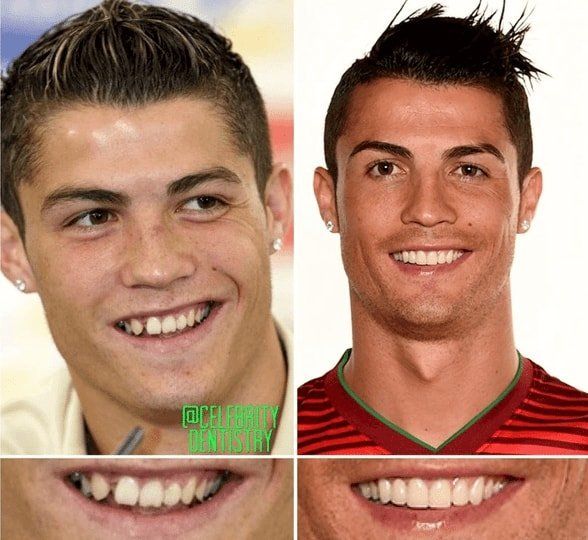 La sonrisa de Cristiano Ronaldo antes y después de un tratamiento dental, mostrando el cambio en la apariencia de sus dientes.