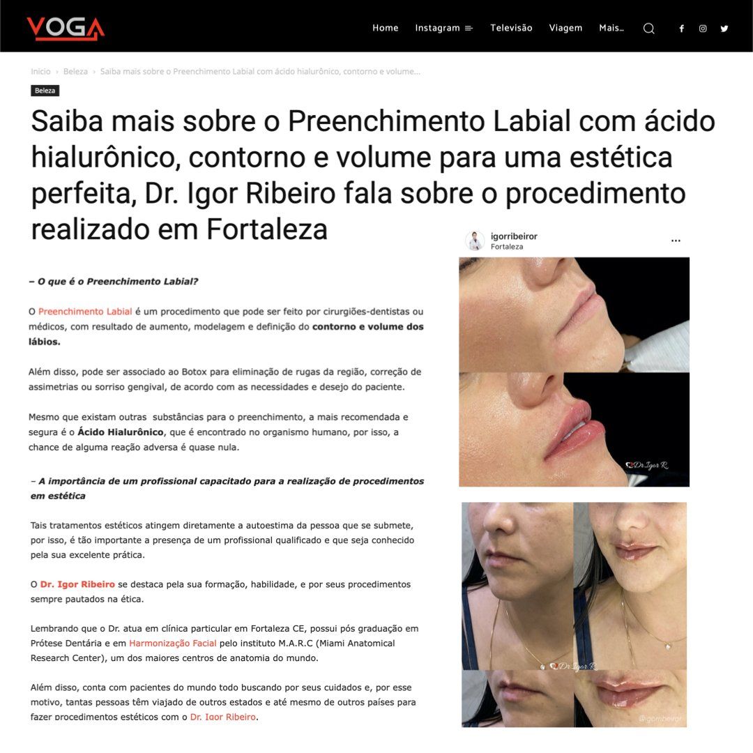 Articolo sui filler per le labbra con acido ialuronico del Dott. Igor Ribeiro a Fortaleza, con foto del prima e del dopo.