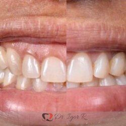 tratamento de gengivoplastia ou plástica gengival antes e depois para sorriso gengival
