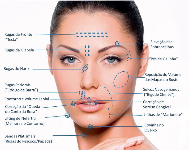 Schéma du visage d'une femme avec des lignes pointillées indiquant les zones à traiter par des traitements esthétiques, notamment les rides et la correction des volumes.