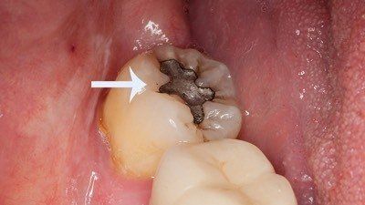 Close-up of a mouth showing a molar with a dark filling and an arrow pointing to the tooth.