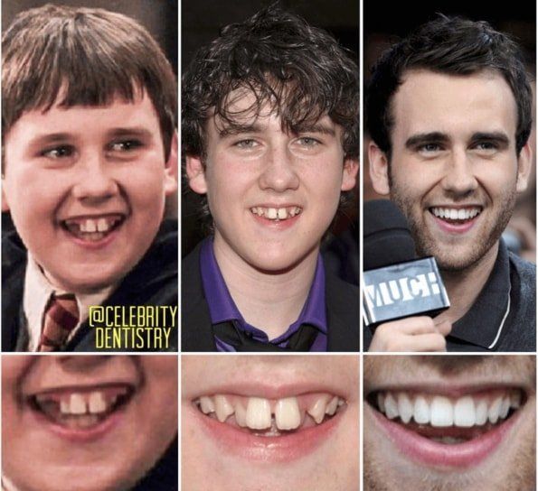 Tres fotos de Matthew Lewis, que muestran su sonrisa a lo largo de su vida, con la última imagen mostrando su sonrisa perfecta.