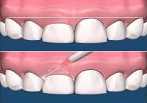 plastica gengival antes e depois plastica gengival com bisturi elétrico resultado imediato antes e depois clinica localizada na cidade de fortaleza