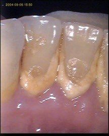 Close-up of teeth with yellowish plaque buildup along the gum line. Pink gums are visible.