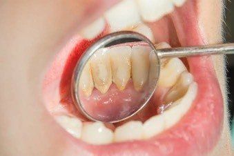 Teeth with significant yellow plaque buildup viewed with a dental mirror during a dental examination.
