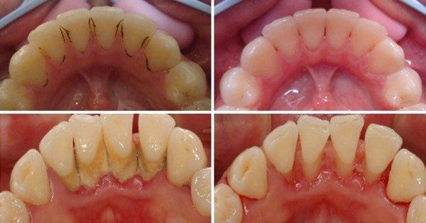 Four views of teeth before and after cleaning: yellowed to white, showing improved oral hygiene.