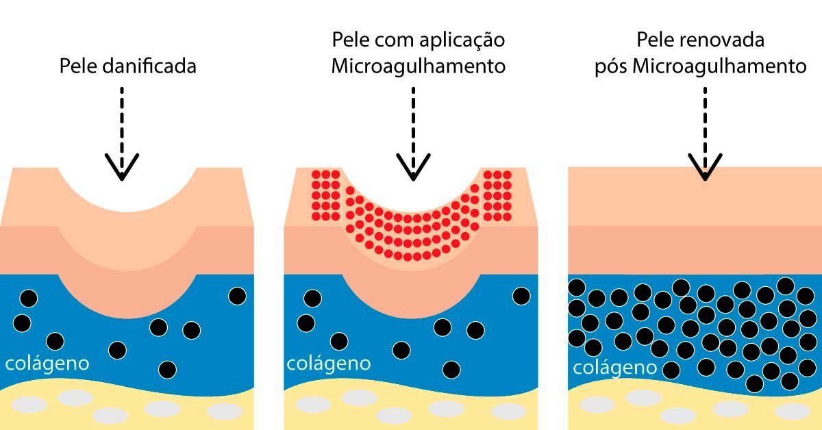 Diagrama mostrando a pele antes, durante e depois da microagulhamento, com aumento da produção de colágeno.