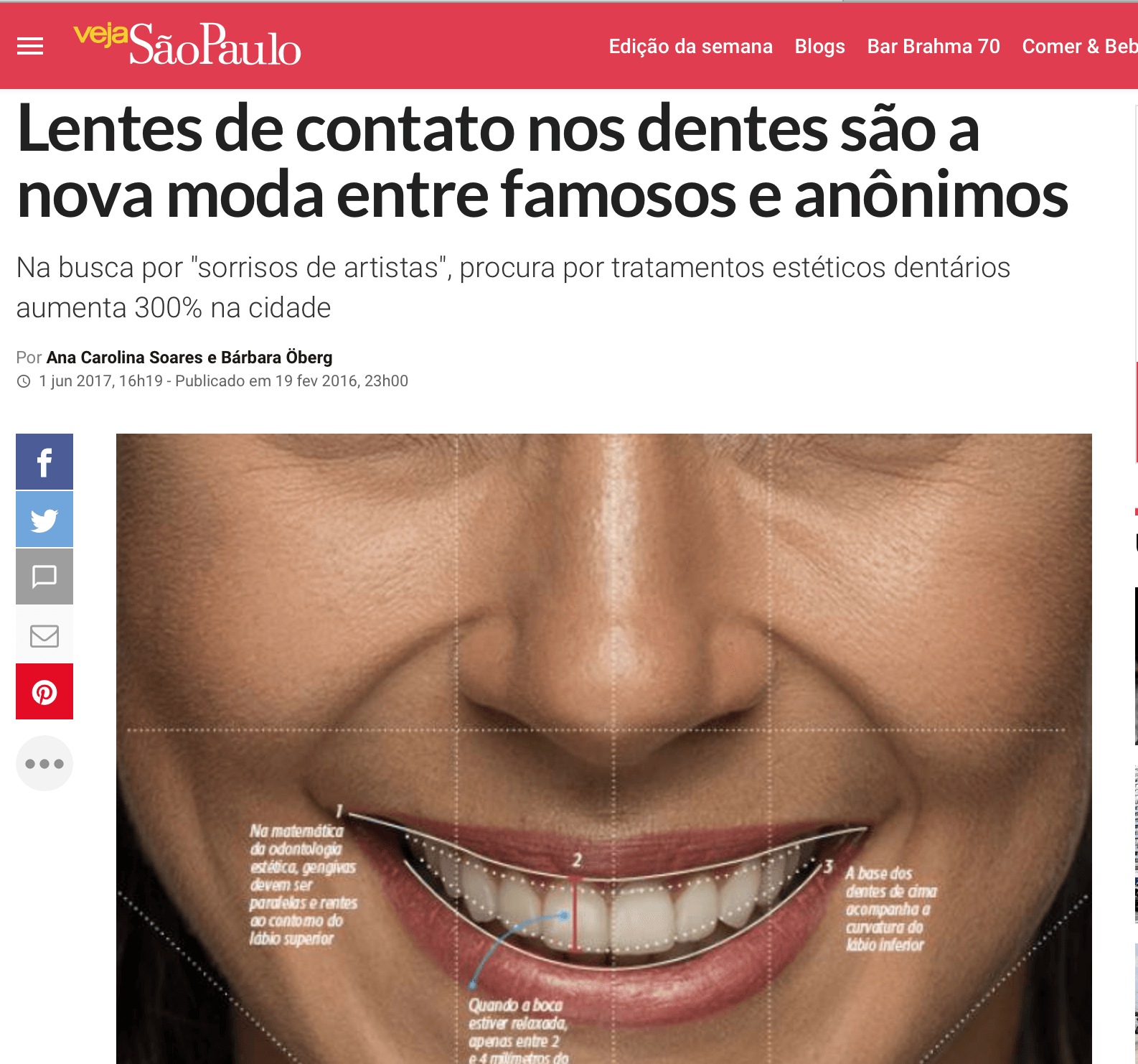Articolo sulle faccette dentali. Primo piano di una donna sorridente con linee sui denti. Sfondo rosso e bianco.