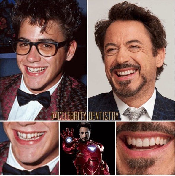 La transformación dental de Robert Downey Jr.: fotos del antes y el después, con el traje de Iron Man.