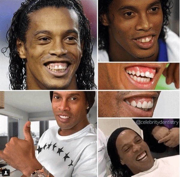 Los dientes de Ronaldinho antes y después de su tratamiento dental. Las fotos muestran su sonrisa, con espacios inicialmente y luego una sonrisa restaurada.