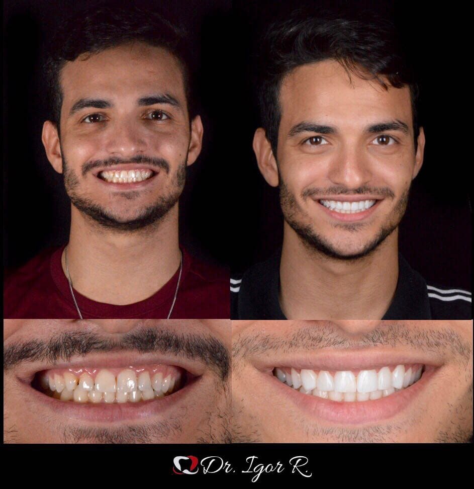 Antes y después de un tratamiento dental. Hombre sonriendo; dientes originales manchados, dientes nuevos de un blanco brillante.