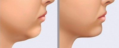 imagem de lipo de papada antes e depois com resultado da lipo enzimática removendo a gordura localizada submetual em clinica em fortaleza