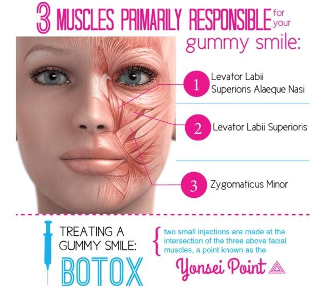 tratamento de sorriso gengival através de Botox (Toxina Botulínica) para diminuir a força da musculatura e amenizar o sorriso gengival, essa técnica é usada em conjunto com Gengivoplastia ou Gengivectomia