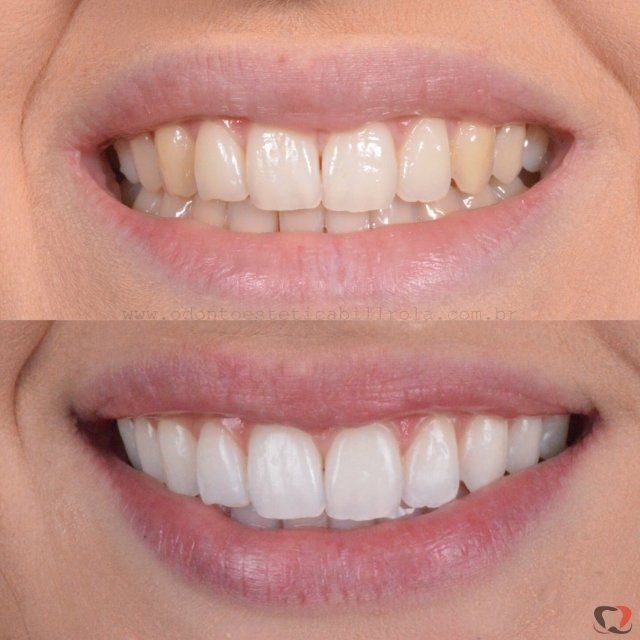 resultado final de clareamento caseiro  e clareamento a laser em paciente antes e depois comparação