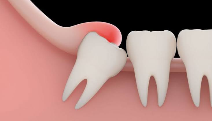 La imagen muestra una muela del juicio inclinada, con inflamación roja, presionando contra los dientes adyacentes en encías rosadas.