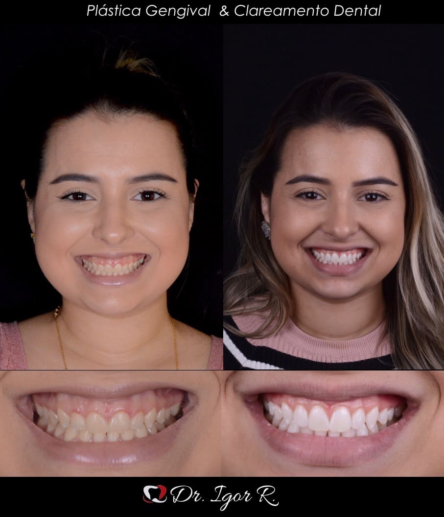 Antes y después de un tratamiento dental; mujer sonriente con dientes oscuros versus dientes blancos brillantes.