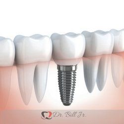 Implante dentário com coroa, mostrado entre dentes naturais contra um fundo laranja desfocado.