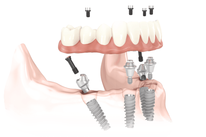 lente de contato dental x lente de contato lentes de contato dental tratamento etético odontológico para dentes, odontologia estética em fortaleza ceara
