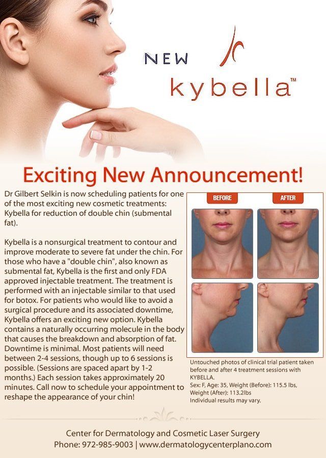 Kybella ad: Woman's profile and before/after photos showcasing double chin reduction. Text promotes the non-surgical treatment.