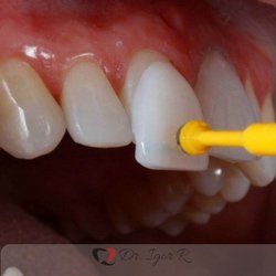 tratamento odontologia estética fortaleza lentes de contato dental ou facetas de porcelana