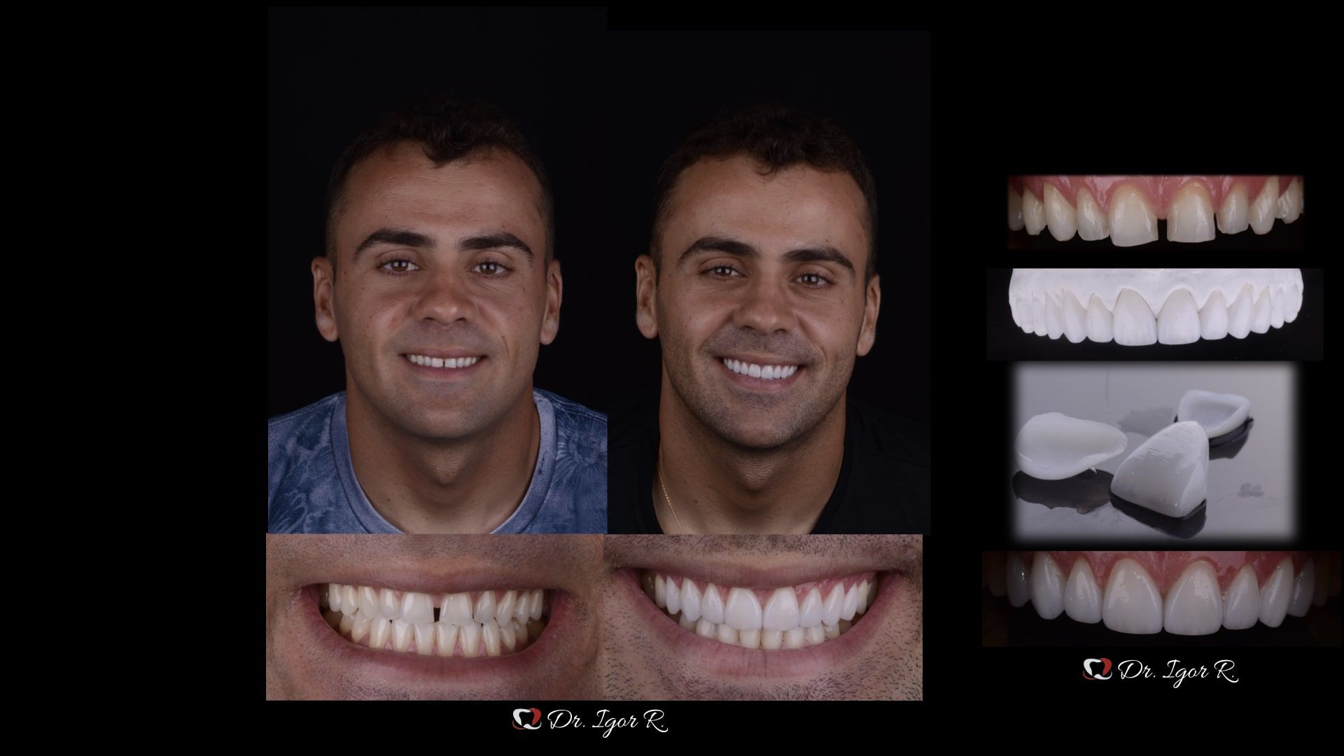 Man with before-and-after smile transformation. Shows cracked teeth then bright white veneers. Side panels detail process.