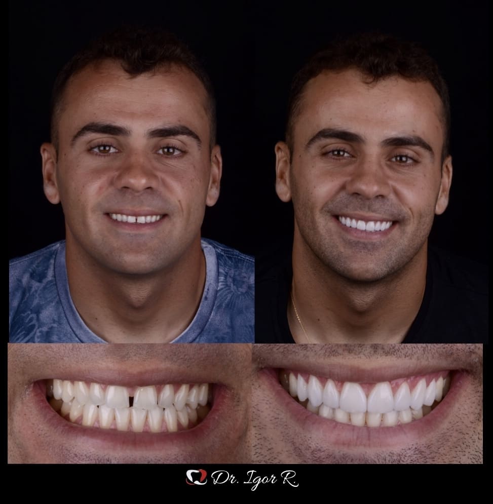 lente de contato dental x lente de contato lentes de contato dental tratamento etético odontológico para dentes, odontologia estética em fortaleza ceara