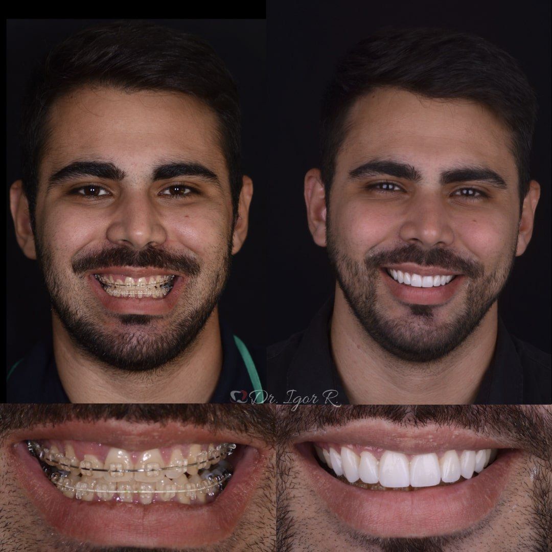 paciente lente de contato dental em fortaleza paciente com tratamento de lentes de contato dental natural, tratamento com lentes de contato ou facetas de porcelana em fortaleza