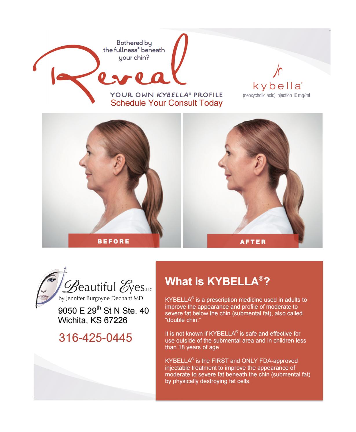Advertisement for Kybella with before and after images of a woman's profile, and a logo for