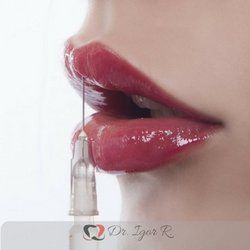 Preenchimento Labial Dr. Igor Ribeiro | Dentista em Fortaleza