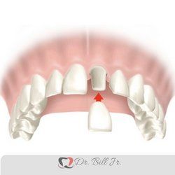 Diagrama da colocação de uma coroa dentária em um dente preparado. A seta vermelha indica a direção.