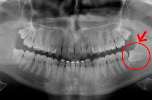 Radiografía dental que muestra los dientes, incluyendo una muela del juicio marcada con un círculo y señalada con una flecha roja.
