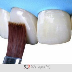 Um pincel aplica uma substância nas facetas dentárias brancas.