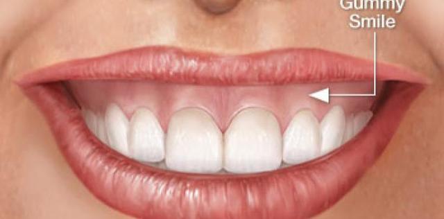 sorriso gengival cirurgia para remoção do excesso de gengival chamada de plástica gengival ou gengivectomia