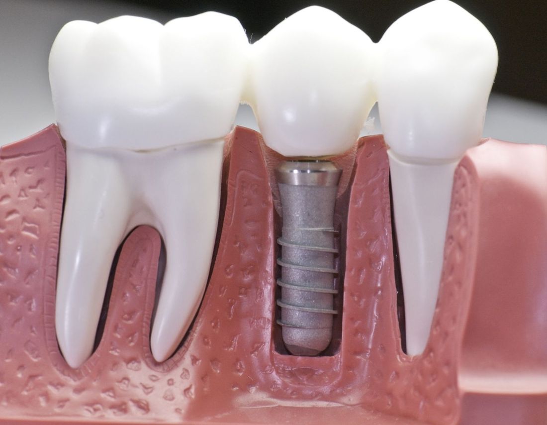 dettaglio impianto dentale
