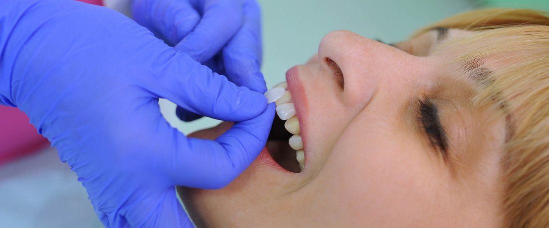 applicazione denti