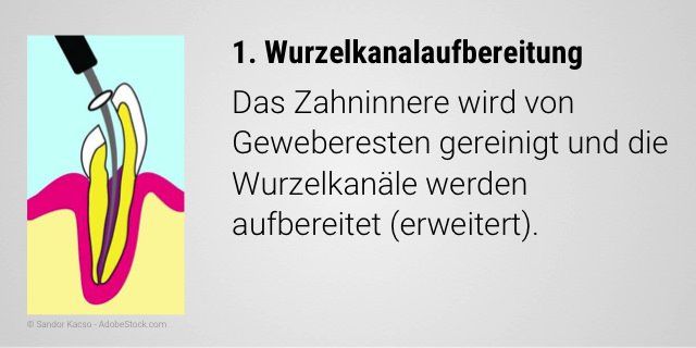 Säuberung des Zahninneren und Aufbereitung der Wurzelkanäle