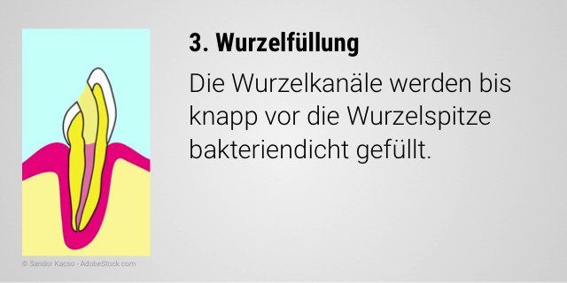 Bakteriendichte Wurzelfüllung bis kurz vor die Wurzelspitze
