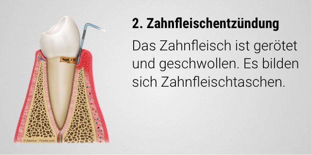Zahnfleischentzündung mit Bildung von Zahnfleischtaschen