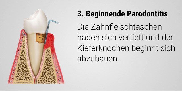 Parodontitis: Tiefere Zahnfleischtaschen und beginnender Abbau des Kieferknochens