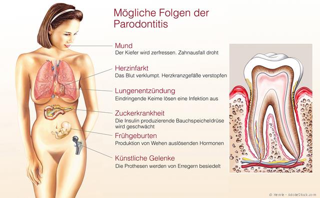 Gesundheitsrisiko Parodontitis: Krankmachende Bakterien gelangen in den Körper und erhöhen das Risiko für Allgemeinerkrankungen. Gesundheitsrisiko Parodontitis: Krankmachende Bakterien gelangen in den Körper und erhöhen das Risiko für Allgemeinerkrankungen.