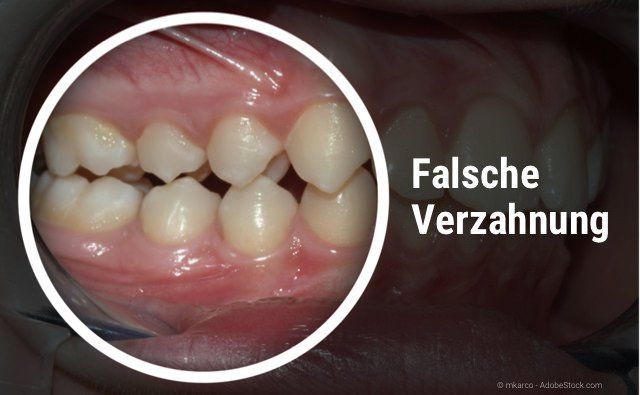 Falscher Zusammenbiss der Ober- und Unterkieferzähne