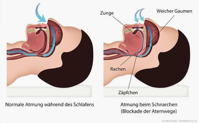 Ursache für das Schnarchen: Zunge und weicher Gaumen blockieren die Atemwege Ursache für das Schnarchen: Zunge und weicher Gaumen blockieren die Atemwege