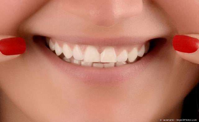 Veneers: Ästhetischer Lückenschluss mit Keramik-Verblendschalen