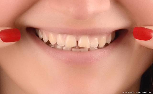 Veneers: Zahnlücke zwischen den oberen mittleren Schneidezähnen vorher
