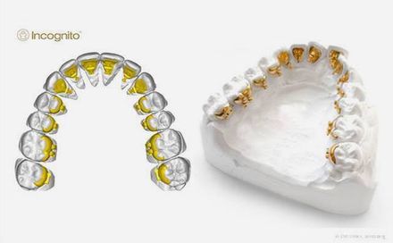 Innenliegende Brackets bei der Incognito-Zahnspange Innenliegende Brackets bei der Incognito-Zahnspange