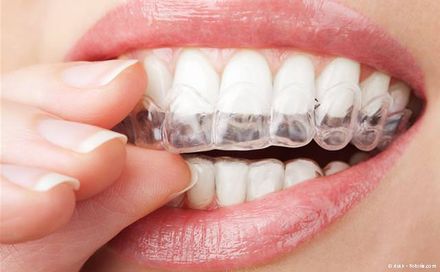 Aligner für unsichtbare Zahnregulierung Aligner für unsichtbare Zahnregulierung