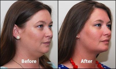 Double chin before after Double chin before after